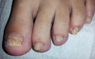 nail-fungus-treatments-peidcures-calgary